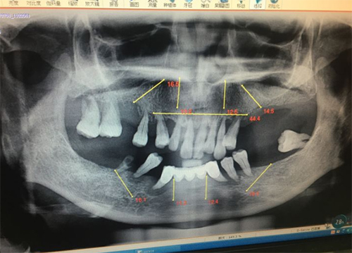 allon4种植牙步骤一CBCT检查