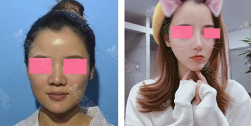 宁波出名的美莱整形医院耳软骨隆鼻对比图