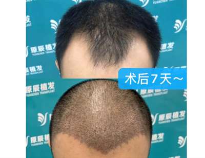 温州原辰植发医院男性头发种植案例