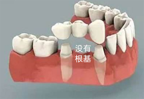镶牙治疗示意图
