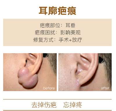 上海清沁医疗美容耳廓疤痕真人案例