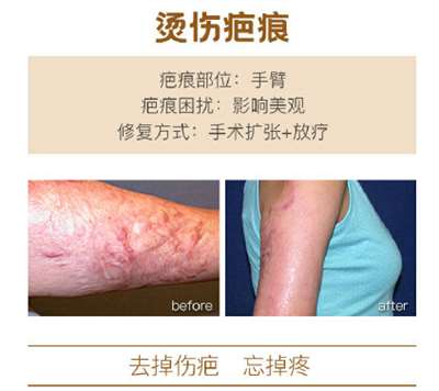 上海清沁医疗美容烫伤疤痕修复前后