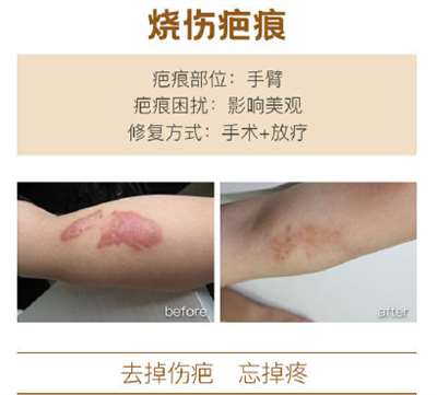 上海清沁医疗美容烧伤疤痕修复