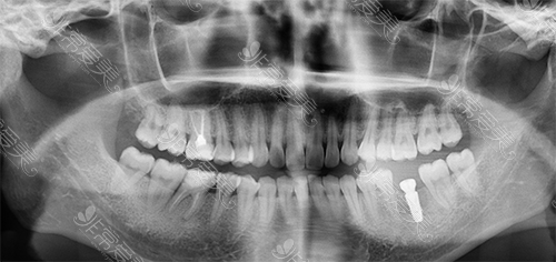 种植牙亲身经历CT照片