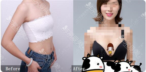 宁波美莱医院隆胸手术前后照片 宁波美莱医院隆胸手术前后照片