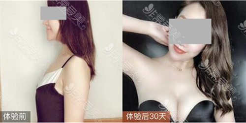 宁波整形外科医院隆胸前后对比照片清晰 宁波整形外科医院隆胸前后对比照片清晰