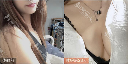 宁波薇琳整形医院丰胸案例真实效果图 宁波薇琳整形医院丰胸案例真实效果图