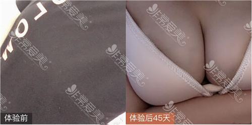 宁波隆胸哪家医院好 宁波隆胸哪家医院好