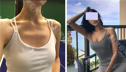 宁波丰胸哪里比较好 宁波丰胸哪里比较好