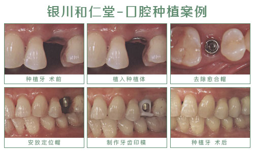 银川种植牙哪家好,看和仁堂与华美种植特色及价格！