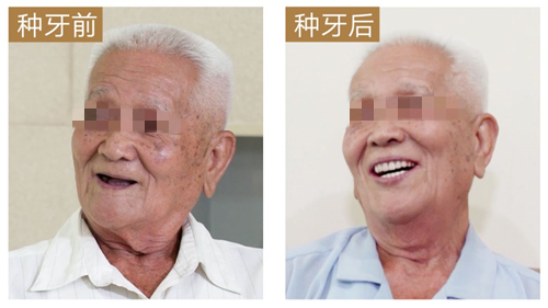 湛江种植牙哪里比较好?分享致美口腔90岁老人全口种植