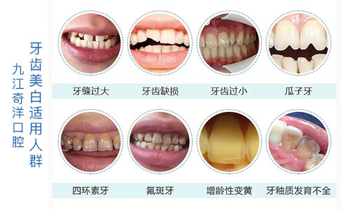 九江口碑好的口腔医院中,奇洋口腔牙齿美白方式\价格如何?