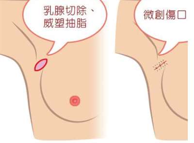 副乳怎么才能消除，多久可以恢复，副乳手术一般多少钱？