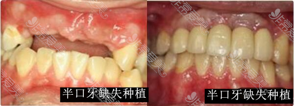 深圳尔睦口腔门诊部半口牙缺失种植对比照