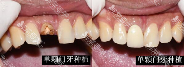尔睦口腔壆岗门诊部单颗牙缺失种植对比照
