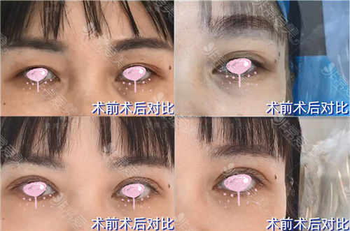 成都恒博天姿眼部整形怎么样? 成都恒博天姿眼部整形怎么样?