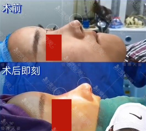 成都恒博医院肋骨鼻术后即刻效果怎么样 成都恒博医院肋骨鼻术后即刻效果怎么样