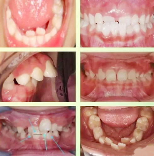儿童牙齿畸形情况