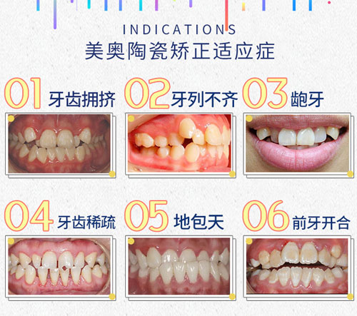 陶瓷矫正适应症