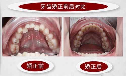 许昌京州口腔牙齿矫正对比