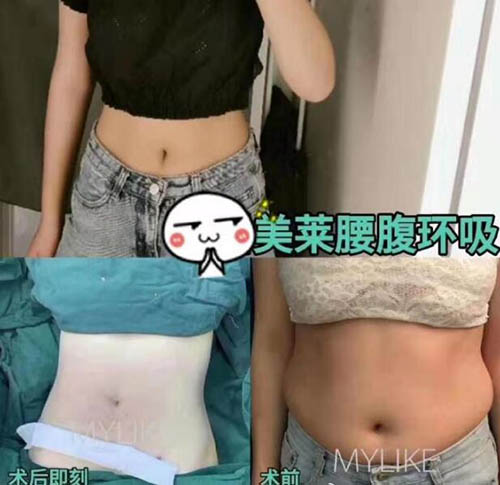 石家庄美莱吸脂医生有几位?揭秘吸脂四项优势拒绝疤痕风险!