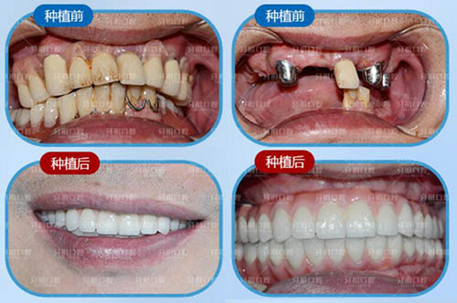 長沙牙祖口腔牙立得全口修復