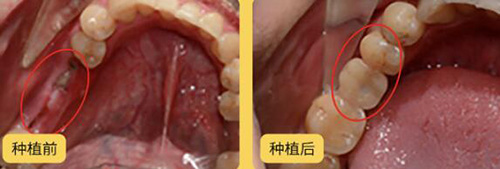 长沙牙祖口腔多颗牙缺失种植