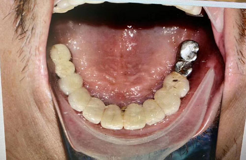 长沙牙祖口腔种植牙术前照