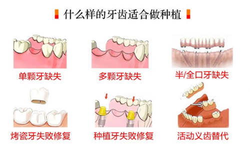 长春超龙牙博士口腔哪种人适合种植牙