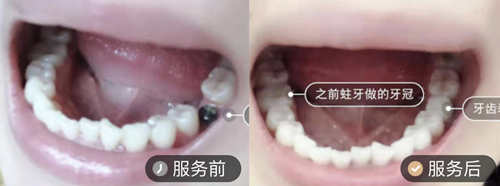 长春超龙牙博士牙齿缺失案例