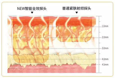 石家莊面容管家熱瑪吉探頭對比