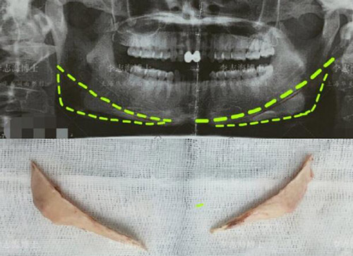 上海李志海下颌角磨骨照片