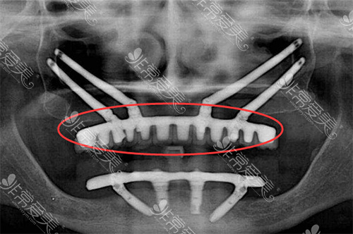 全口种植牙方法CT照