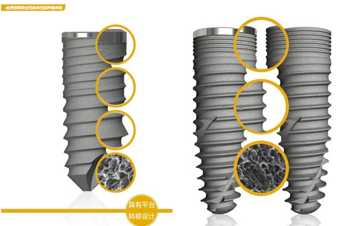 种牙种植体的选择三要素,第一要看稳固性,这些德瑞遥遥领先