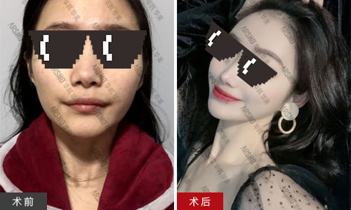 长沙华韩华美做鼻部整形效果如何?公开孙玥玥院长做的鼻子