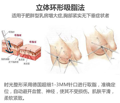 吸脂缩乳手术方式介绍