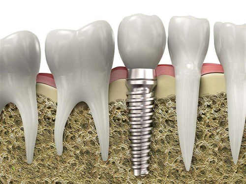 成都军大口腔种植牙示例