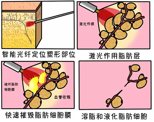 沈阳百嘉丽溶脂设备介绍