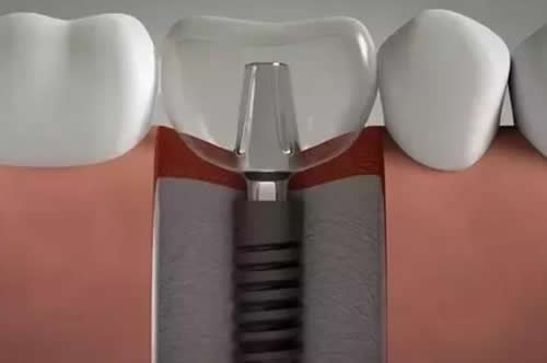 牙医会告诉你种植牙有寿命吗,为什么都说5年后需要更换？
