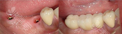 部分牙齿缺失种植修复对比