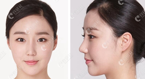 在韩国必当归做耳软骨隆鼻+面部脂肪填充术后