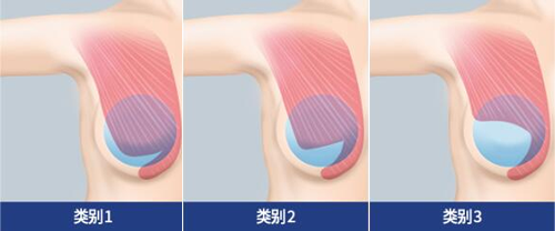 麦恩整形产后胸部提升,蓓菈假体+胸大肌改善活动价78888元!