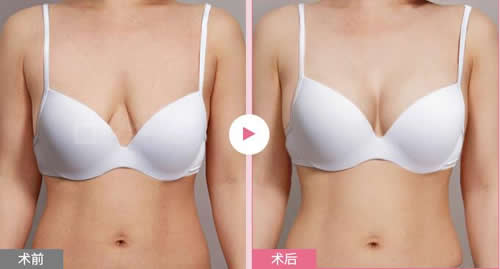 韩国麦恩整形外科胸部提升案例展示 韩国麦恩整形外科胸部提升案例展示