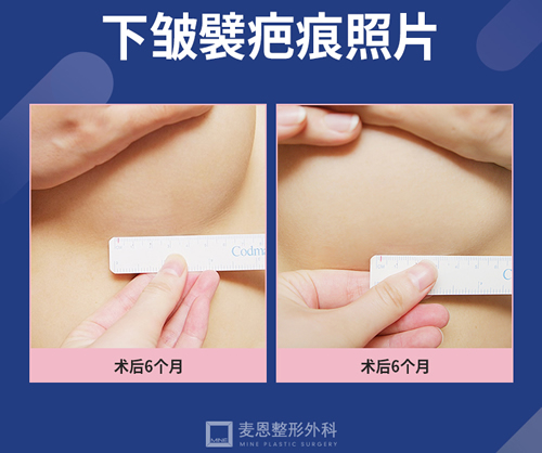 韩国麦恩整形外科胸部提升疤痕展示 韩国麦恩整形外科胸部提升疤痕展示