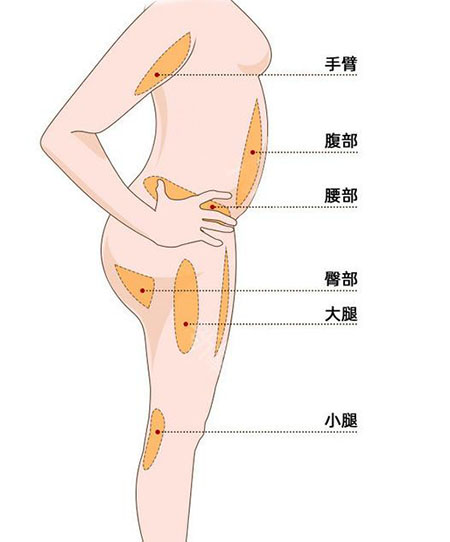 唐山金荣医院吸脂部位