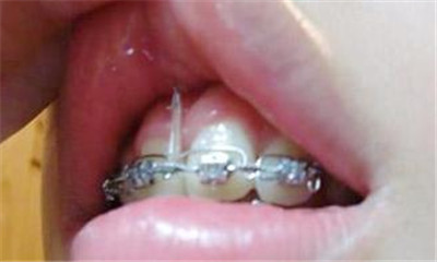 唇系带手术是啥有什么后遗症?会影响牙齿正畸效果吗?