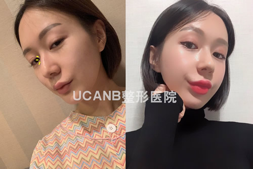 韩国Ucanb整形外科隆鼻和颧骨缩小案例