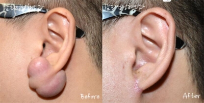 韩国Dr.ham's整形医院耳部瘢痕治疗照片