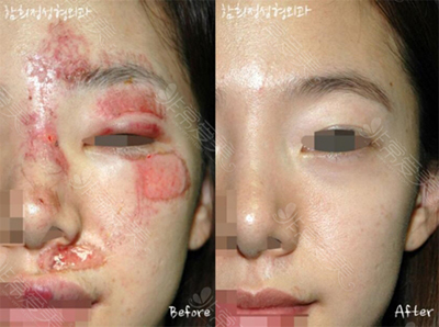 韩国Dr.ham's整形医院烧伤疤痕治疗照片