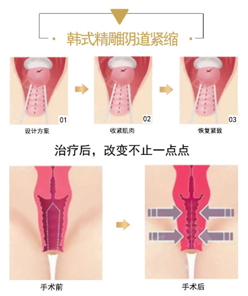 南宁瑞柏美整形医院怎么样阴道紧缩手术